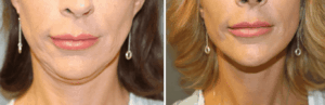 The bottom half of a patient's face before and after a facelift near Brentwood, TN.